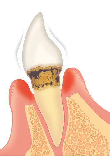 歯周病の進行度